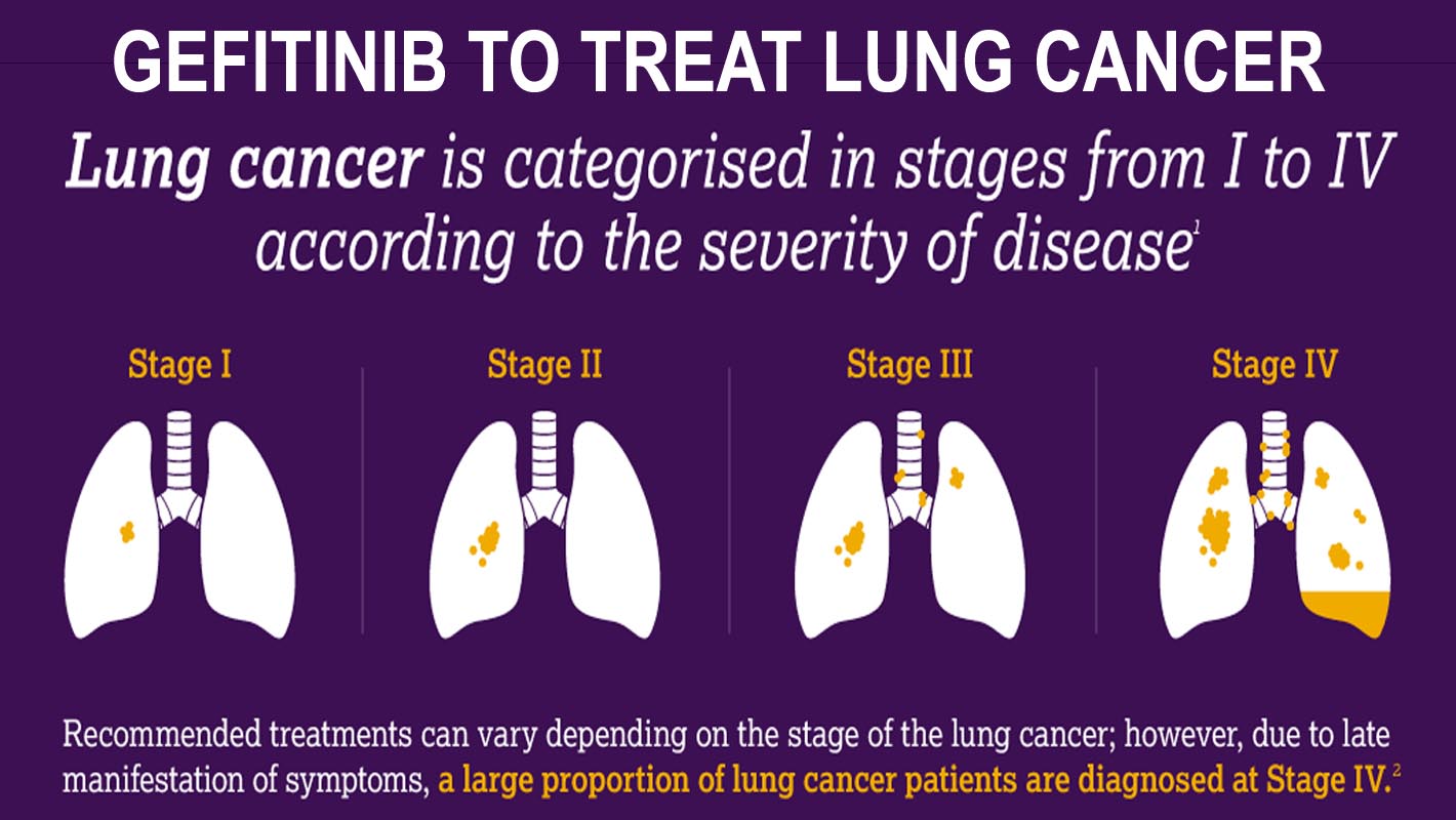The Role of Gefitinib in Treating Non-Small Cell Lung Cancer and Mutated Lung Cancer