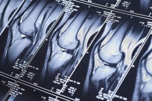 MRI Lower Back Farmington | XRANM