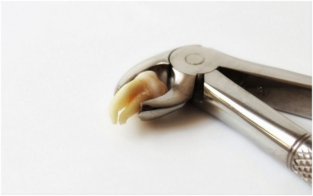 Wisdom Teeth Removal doesn’t have to be Scary!