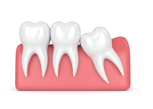 Should You Remove Your Wisdom Tooth – Common Questions Answered