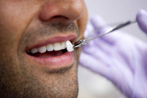 Porcelain Veneers One of the Best Solution For Whiter Teeth