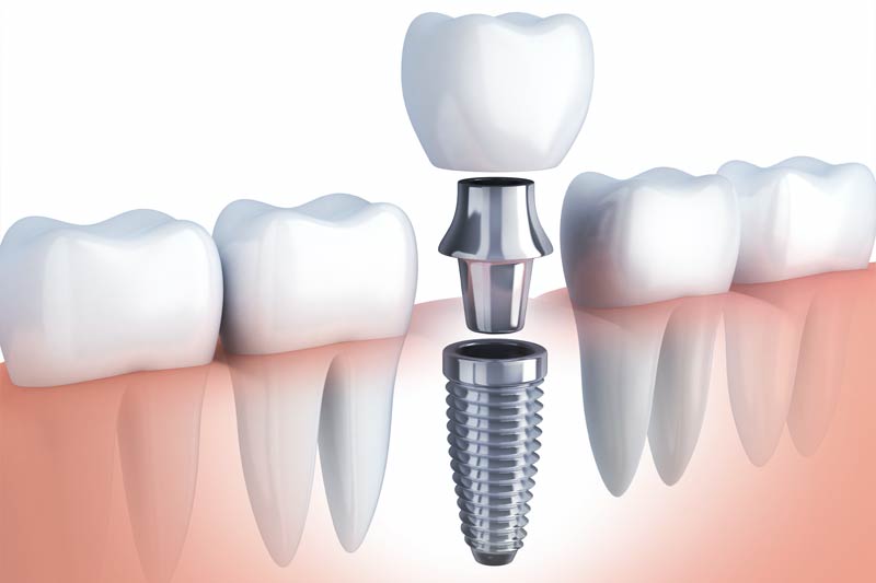 Affordable Dental Implants San Diego @ Mesadentalsd