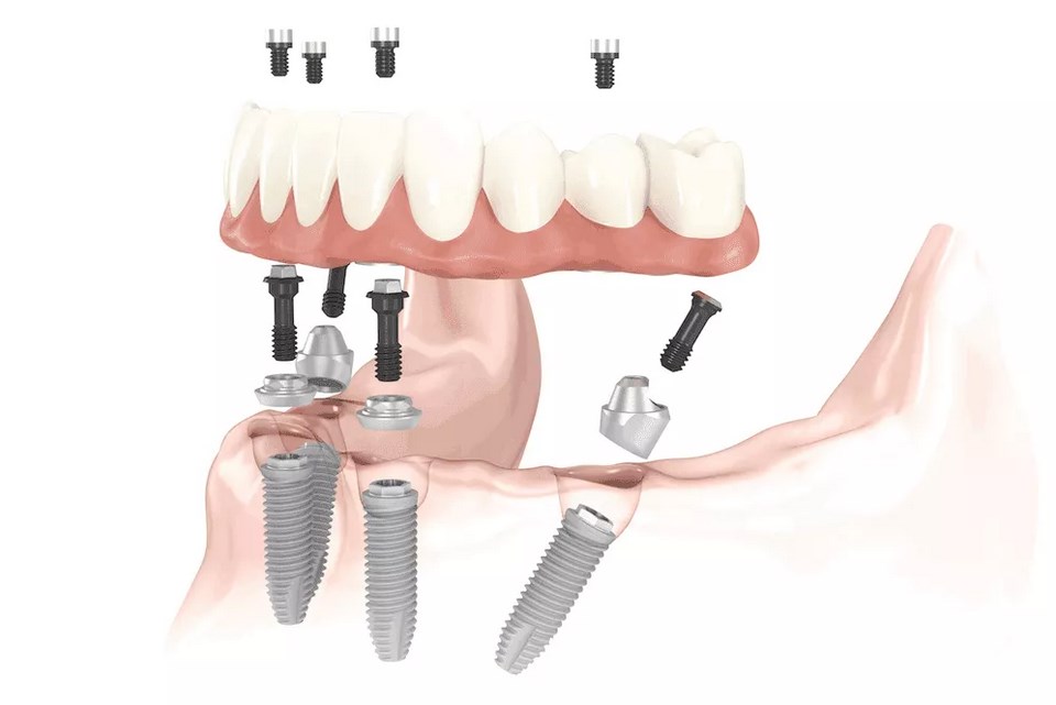 Tooth Implant Cost - What Makes Implants So Expensive?