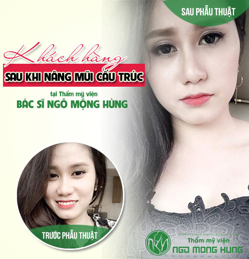 Giá nâng mũi cấu trúc bao nhiêu?