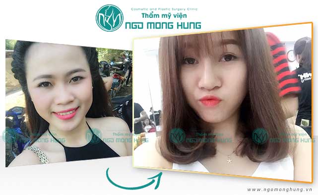 Phẫu thuật nâng mũi giá cả bao nhiêu?