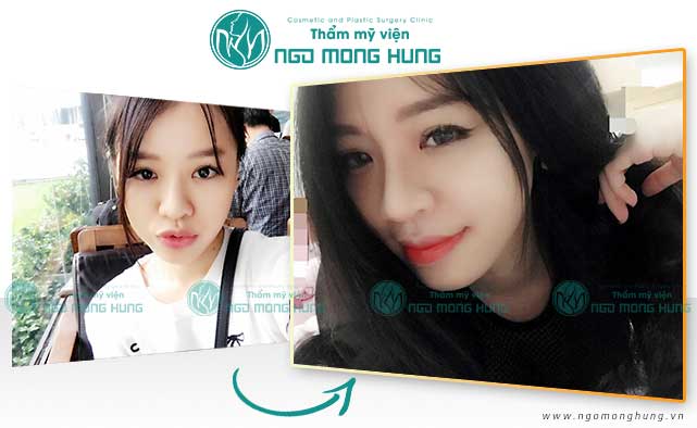 Cắt cánh mũi và thu nhỏ đầu mũi có đau không?