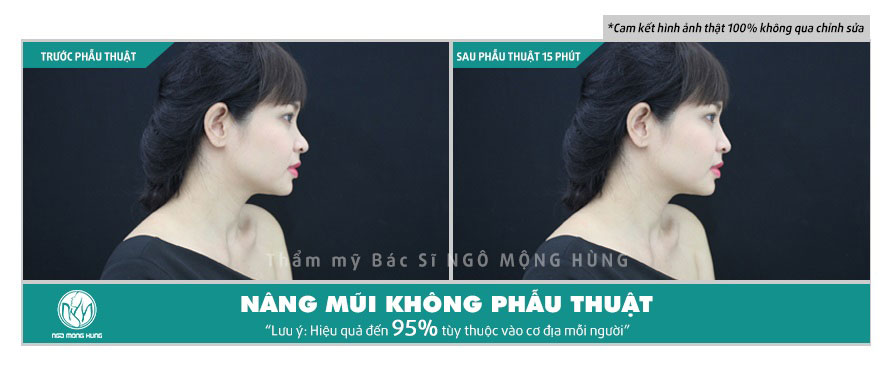 Nâng mũi không phẫu thuật bằng radies là gì?