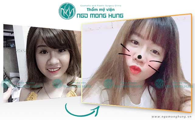 Phẫu thuật thu gọn cánh mũi có để lại sẹo không?