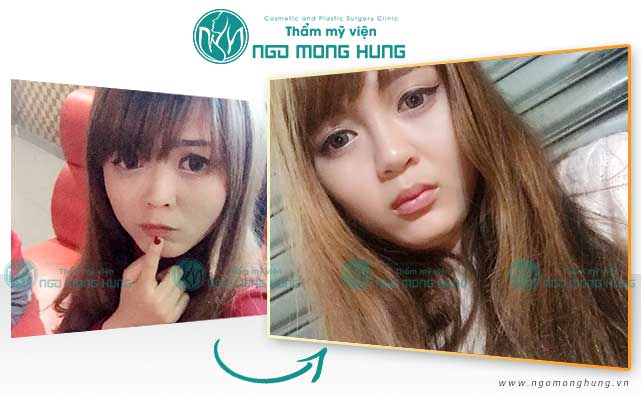 Thẩm mỹ nâng mũi bọc sụn giá rẻ ở đâu