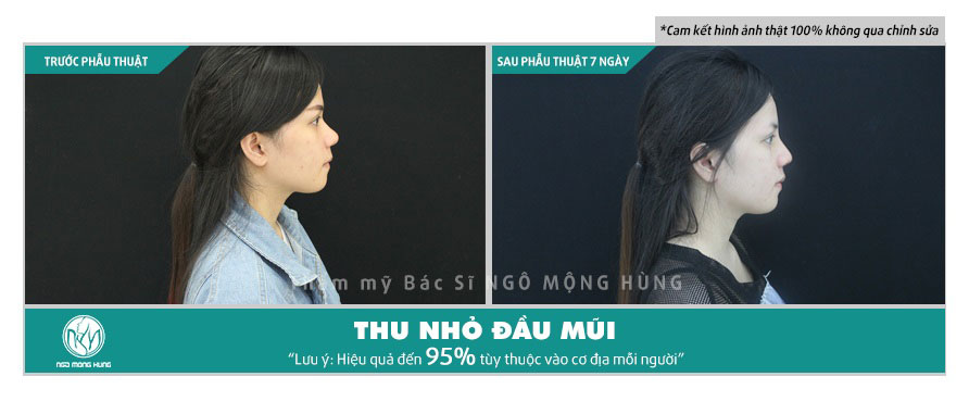 Các cách làm thế nào để thu nhỏ đầu mũi