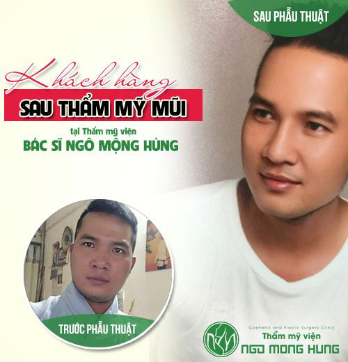 Có nên nâng mũi không phẫu thuật không?