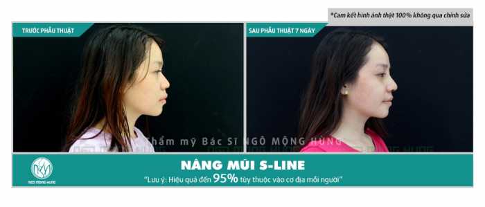 Thẩm mỹ nâng mũi s line có tốt không?