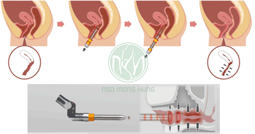 Thu hẹp vùng kín bằng laser có tốt không?