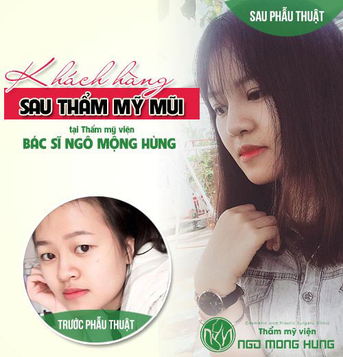 Phẫu thuật thẩm mỹ mũi hàn quốc bao nhiêu tiền
