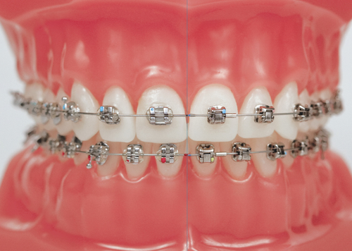 Are You Thinking About Choosing Invisible Braces? 