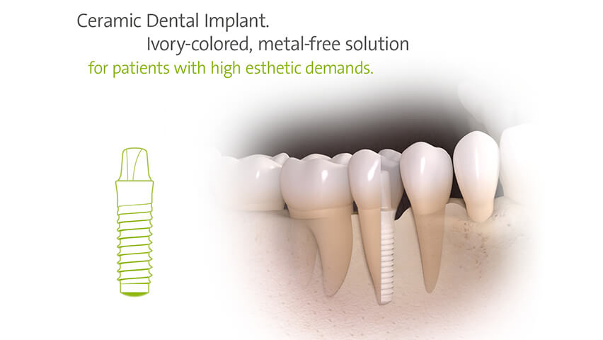 Zirconia Dental Implants Melbourne | Holistic Dental Brunswick
