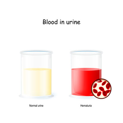 Ayurvedic Treatment for Hematuria