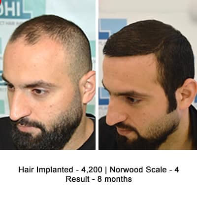 Get A Hair Transplant That Gives Permanent, Natural-Looking Results  By DHI Bangalore