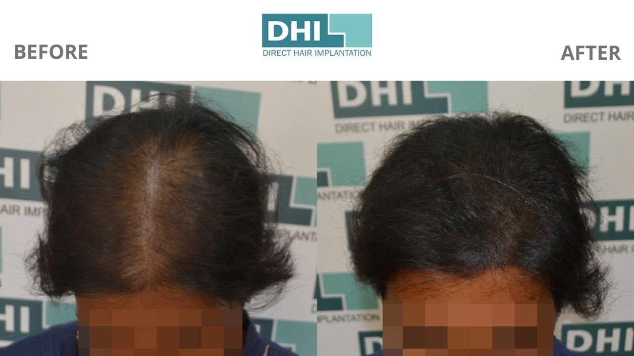 Looking For The Best Hair Transplant In Kolkata?