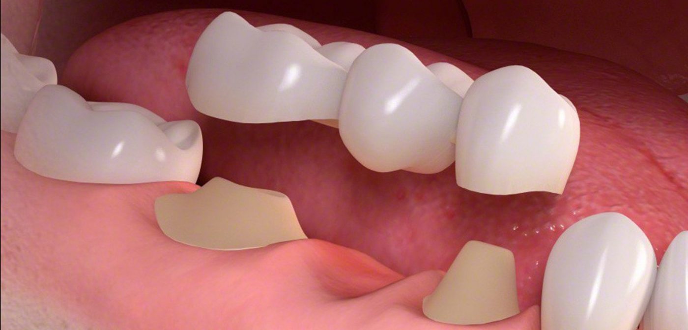 Tips to Help You Identify the Need a Wisdom Tooth Removal