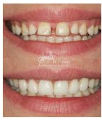 Porcelain Veneers - The Only Method To Ensure A Million Dollar Smile