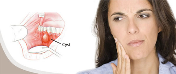 Jaw Cyst Surgery In Delhi