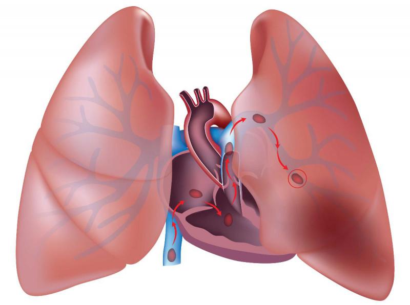 Pulmonary Arterial Hypertension (PAH) treatment has evolved over the years with the availability of oxygen therapy, physical exercise, and medications