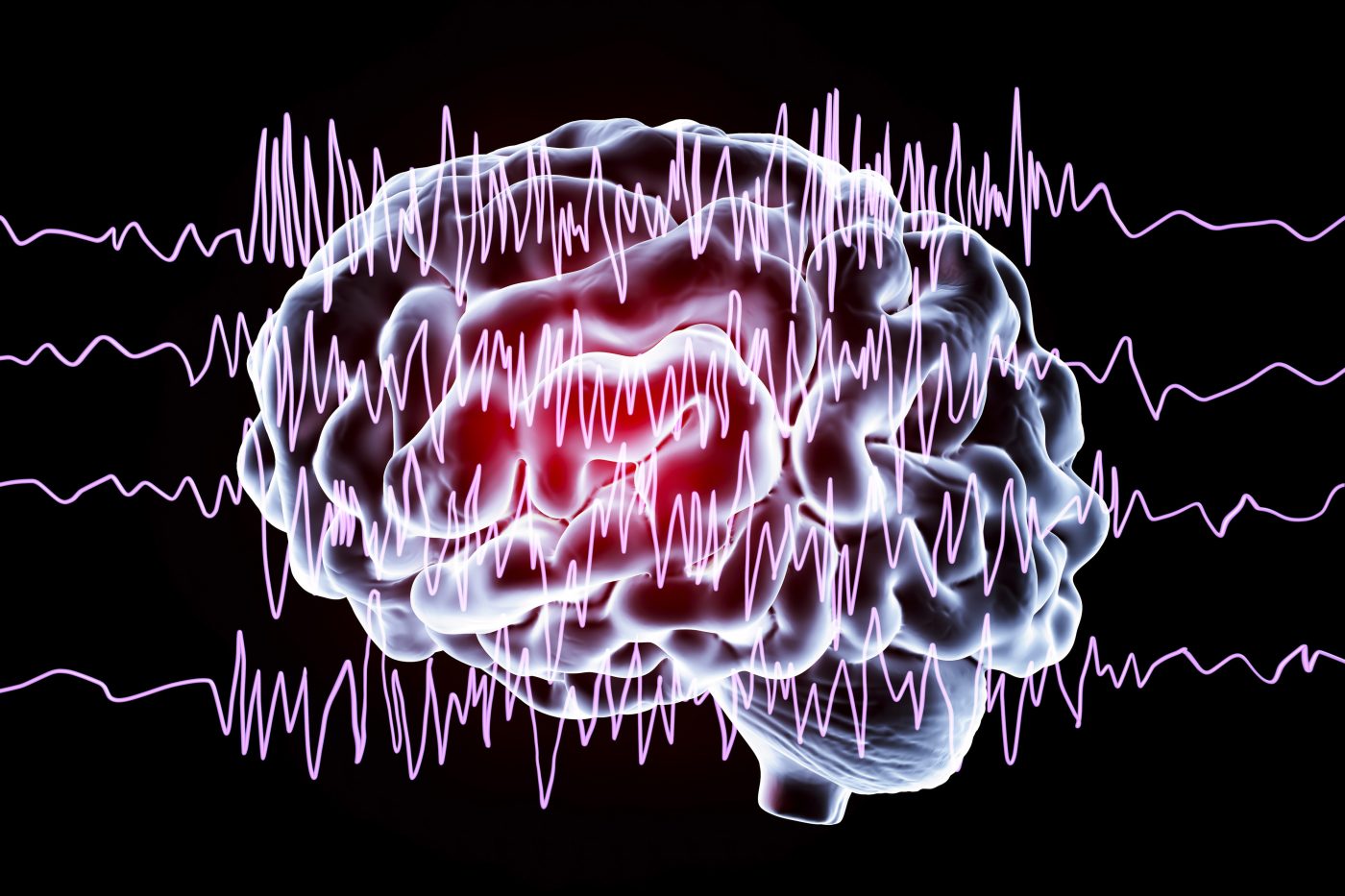Epilepsy: Bright Minds Bio Exploring Serotonin Agonists to Control Seizures
