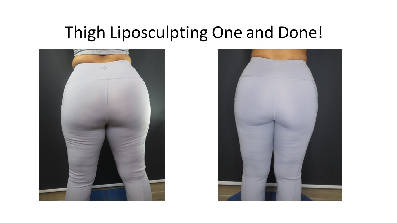 The Difference Between Vaser and Smart Lipo