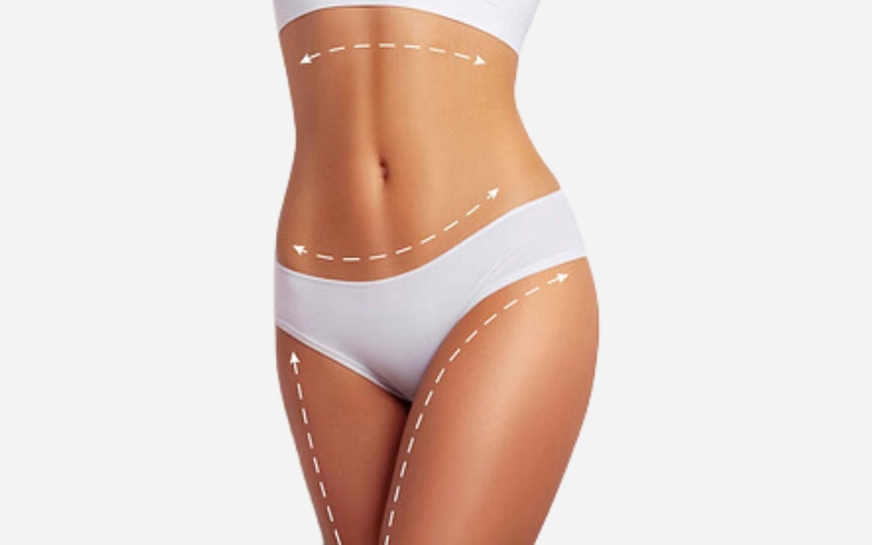  Liposuction in Fort Myers, FL 