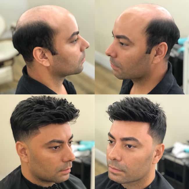 Baldness treatment: Tips and procedure
