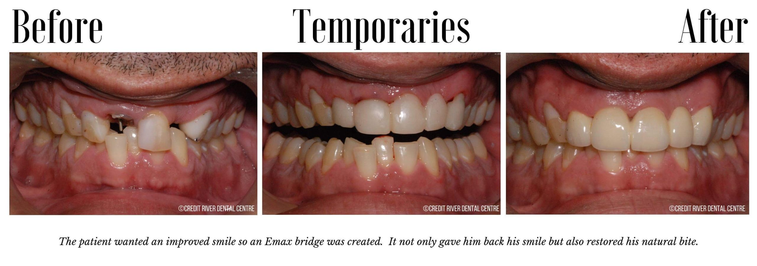 Get a striking smile with the help of porcelain veneers in Mississauga