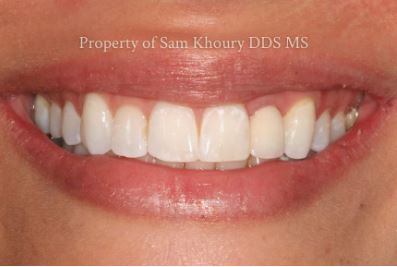 Unleash Your Smile's Potential: Dental Implants in Garnet Valley, PA