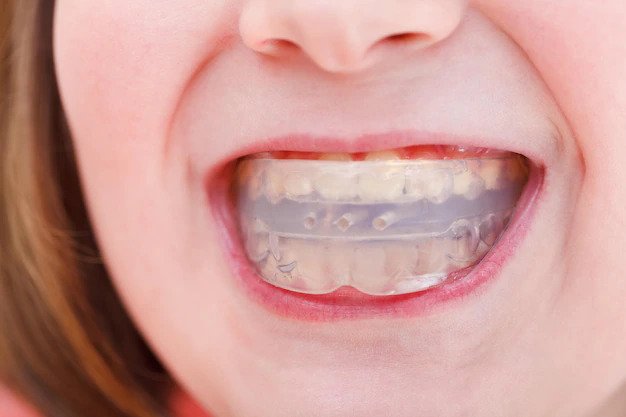 Dentists Say Benefits Of Mouthguards For Sports And Fitness
