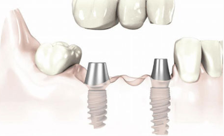 Dental implant and crown: Is This combination right for you?