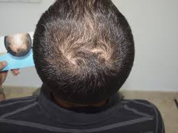 Hair Loss: Possible Causes and Non-Surgical Treatments