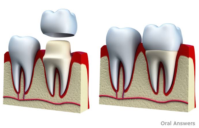 Get Best Dental Crown Procedure in Melbourne