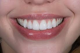 What Are Tooth Veneers?