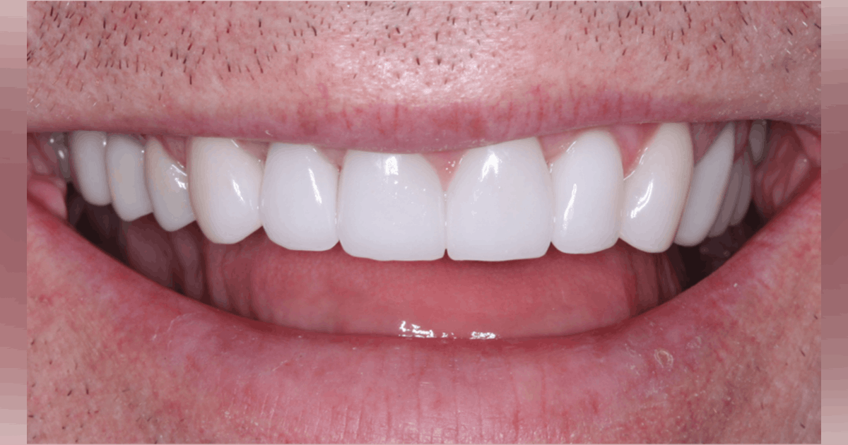 Dental Cement Market to Witness Robust Expansion Throughout the Forecast Period 2022-2027