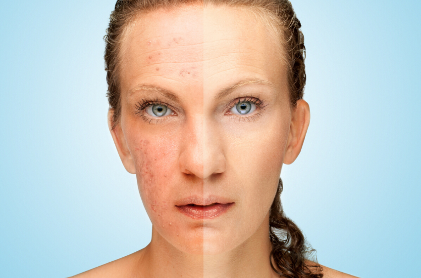 Selenium for Acne & Skin Health