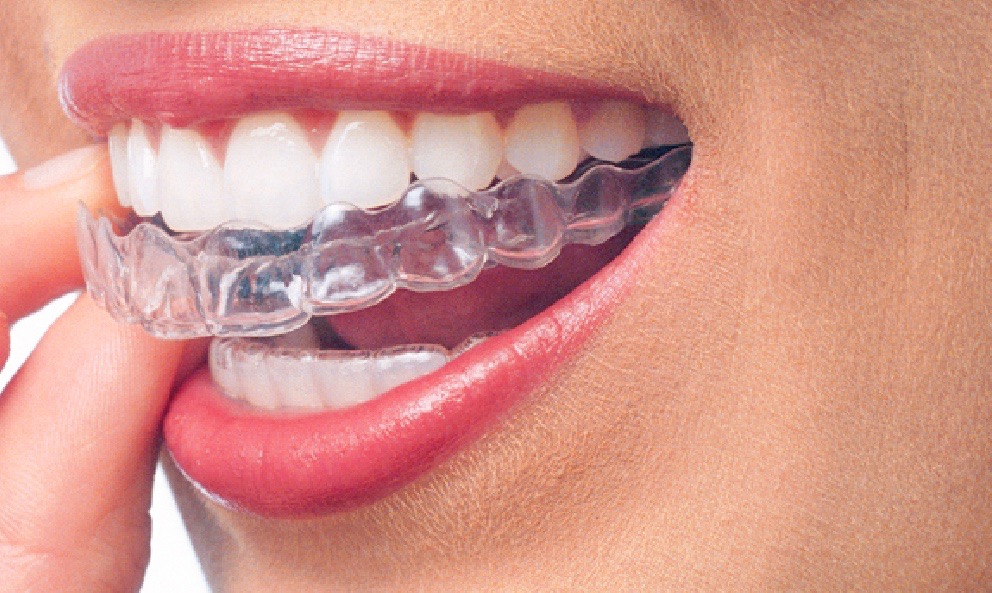 What Do Invisalign Braces Cost? Are They Worth It?