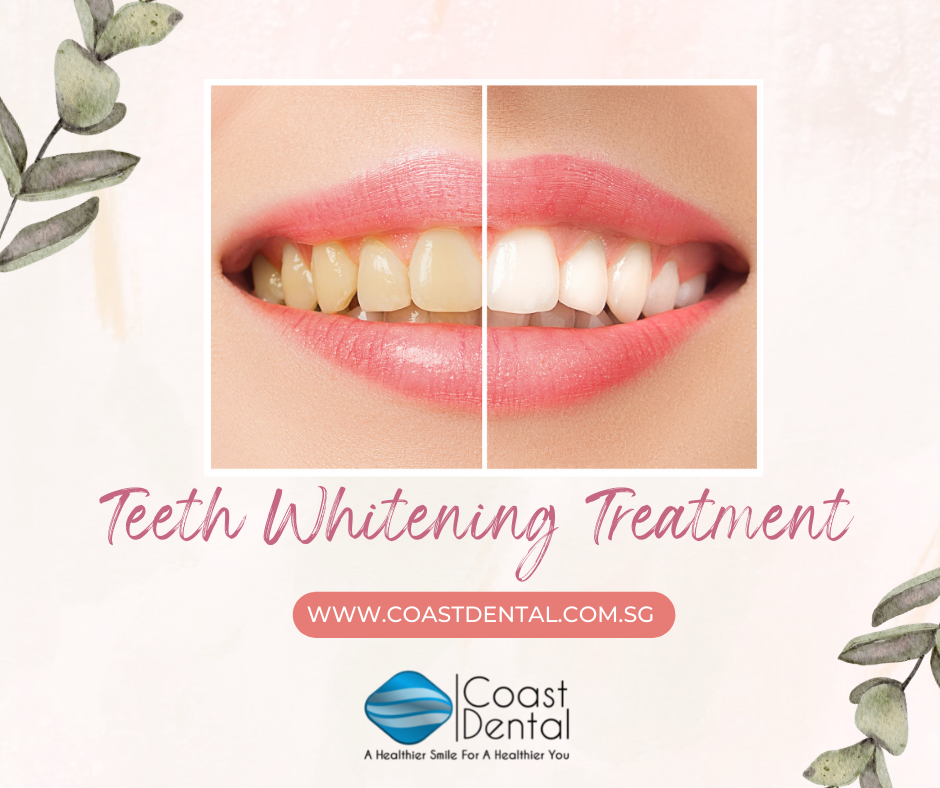 Teeth Whitening Treatment in Singapore