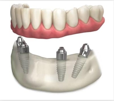 Kinds Of Dental Implants 