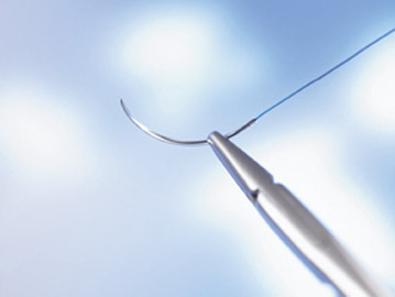 Surgical Sutures Market is Expected to Witness Sustainable Growth During the Forecast Period (2021-2025)