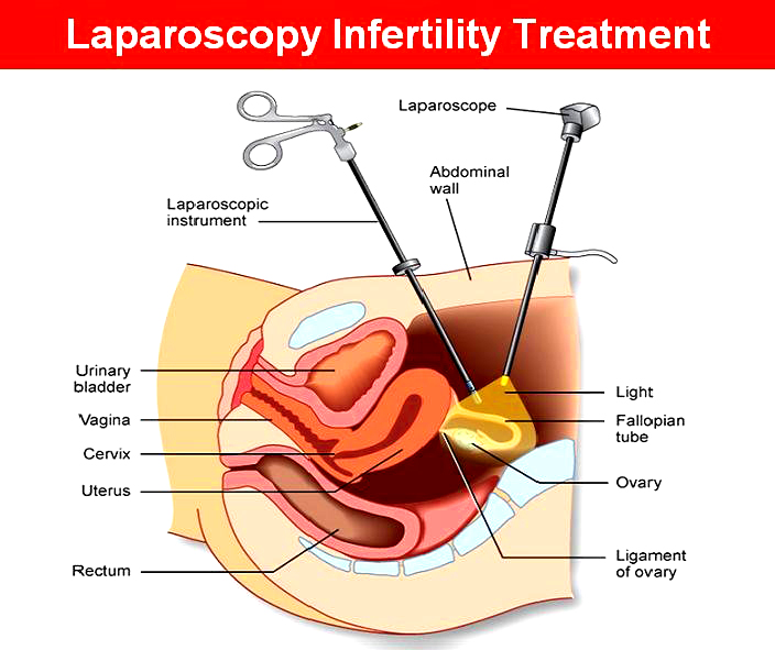 How to Prepare for Laparoscopic Surgery?