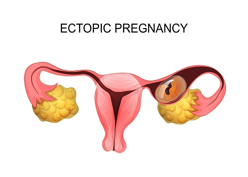 Know All About Ectopic Pregnancy 