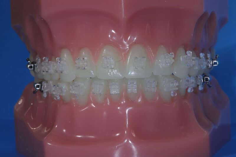Teeth Straightening in Edinburgh