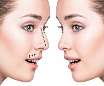 Everything You Need To Know About Dimple Surgery