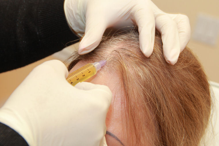 PRP Treatment