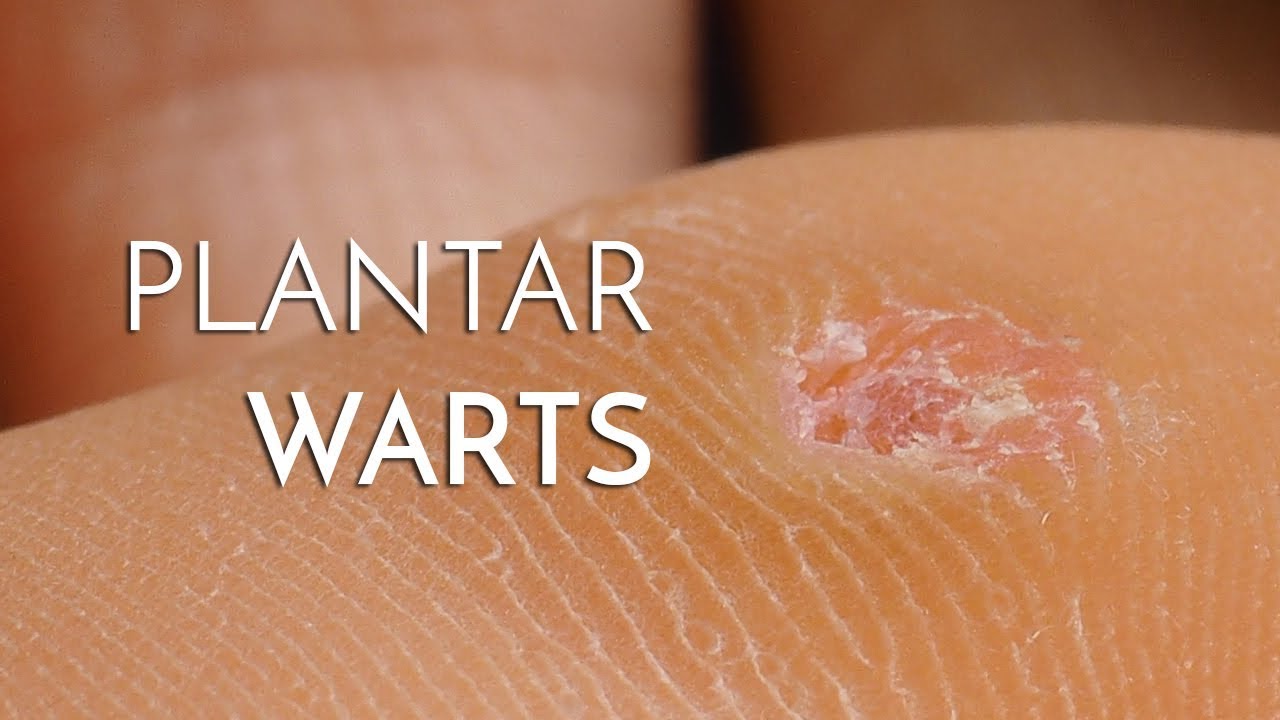 How to Get Rid of Plantar Warts